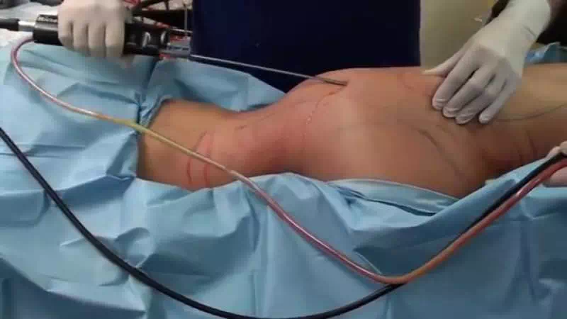 لیپوساکشن لیزری یا از بین بردن با استفاده از لیزر
